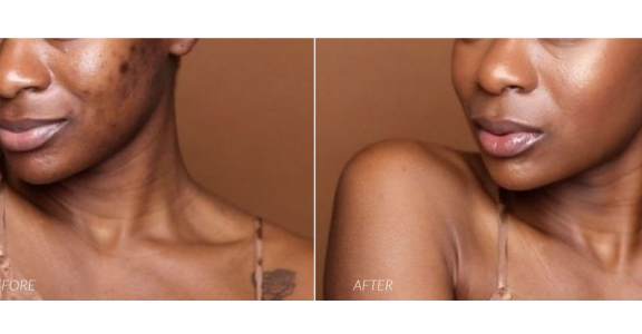 chemical peel